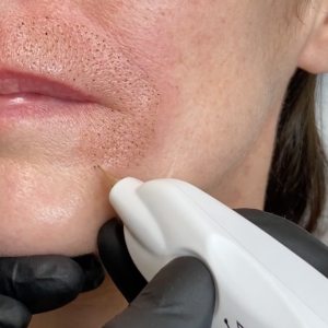 2_PL_FR_LE-PLASMA-LIFT-EN-REGION-LABIO-MENTONNIERE-SUR-MODELE