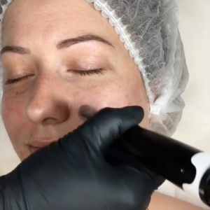 3_MN_FR_LE-MICRONEEDLING-SUR-MODELE